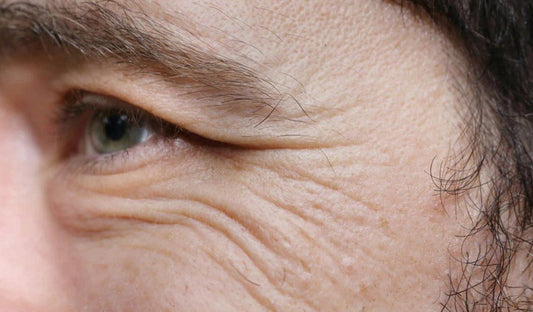Как-да-премахнем-бръчки-около-очите-5-работещи-лечения